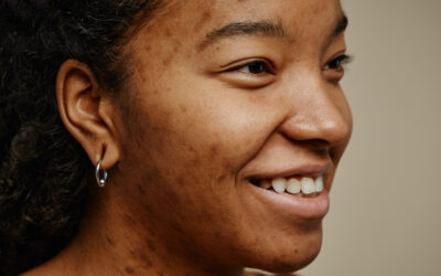 Love the Skin You’re In: Treating Hyperpigmentation the Right Way