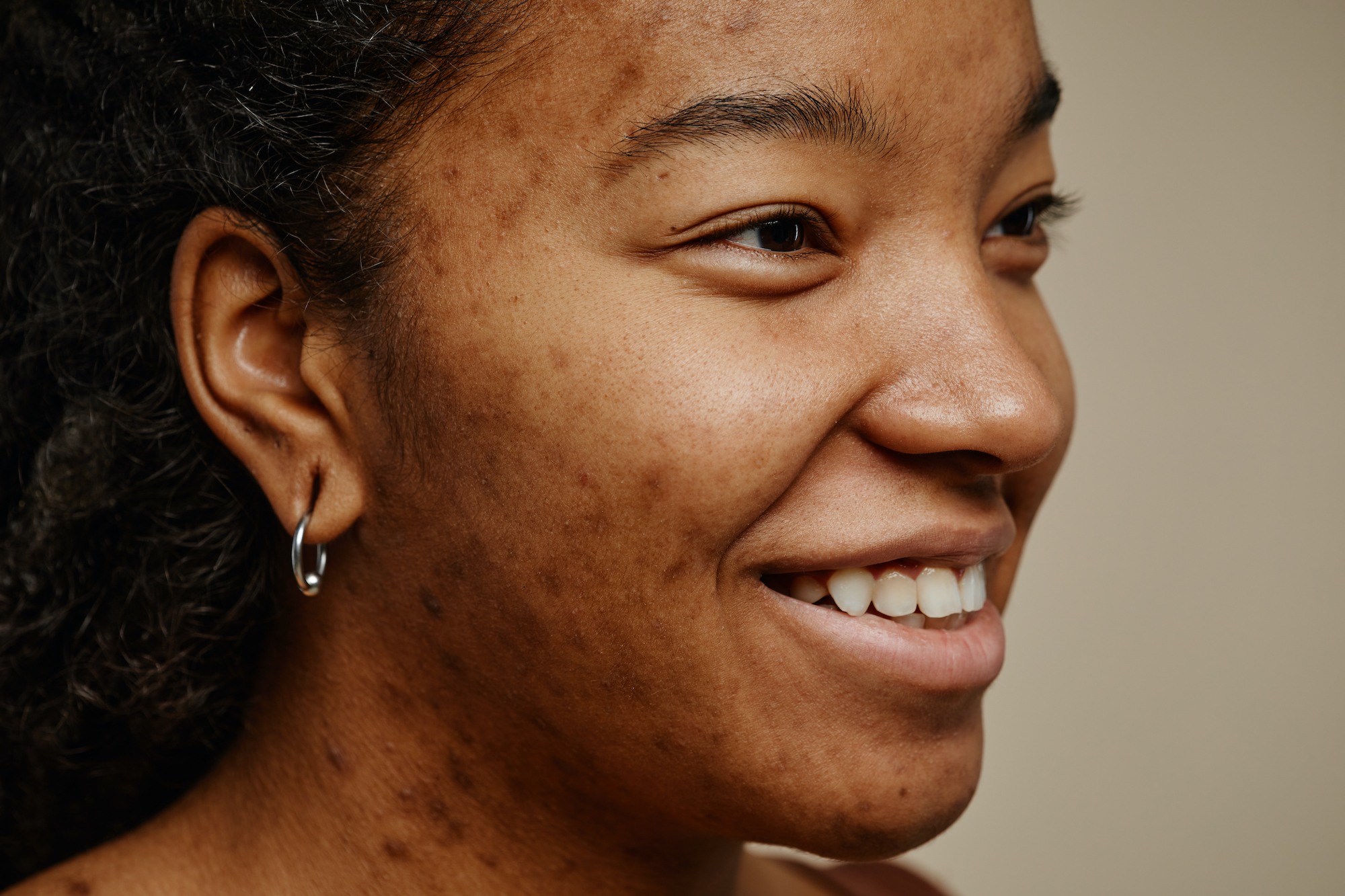 Close up ethnic young woman with acne scars on face smiling