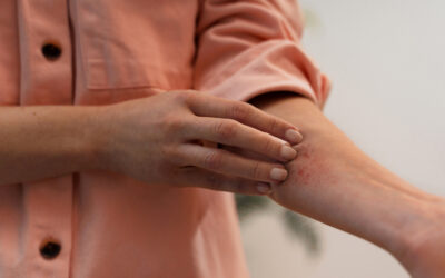 Skin Allergies Explained: Identifying and Treating Contact Dermatitis