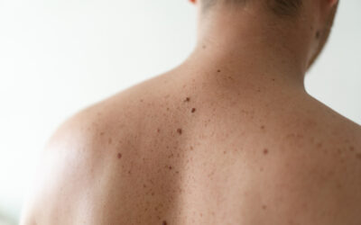 Understanding Skin Moles: What’s Normal and What Needs a Check