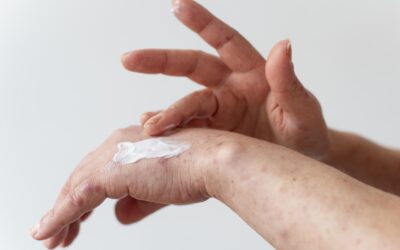 Managing Eczema: Tips for Flare-Free Living