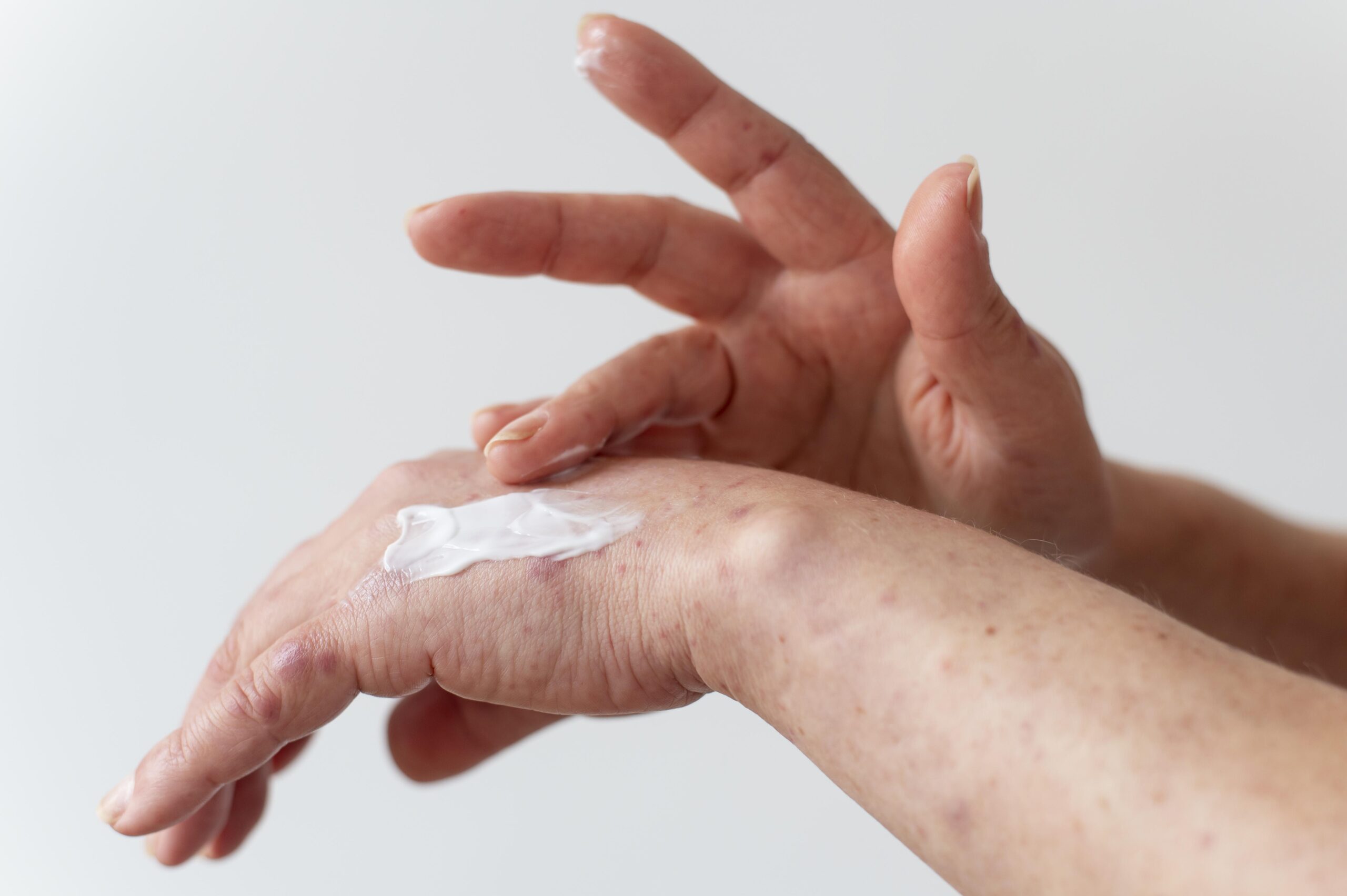 skin-allergy-person-s-arm